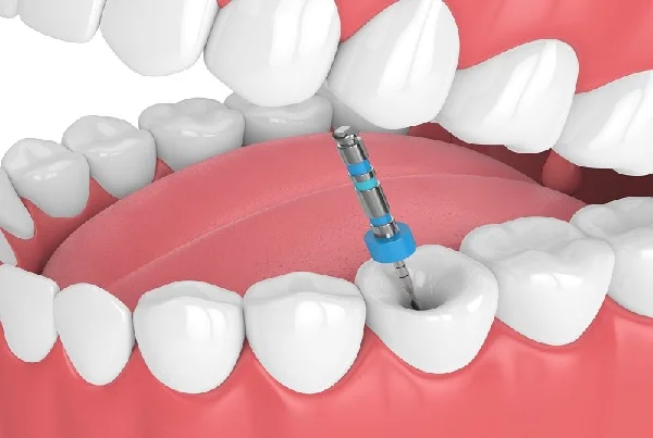 Single Sitting painless RCT