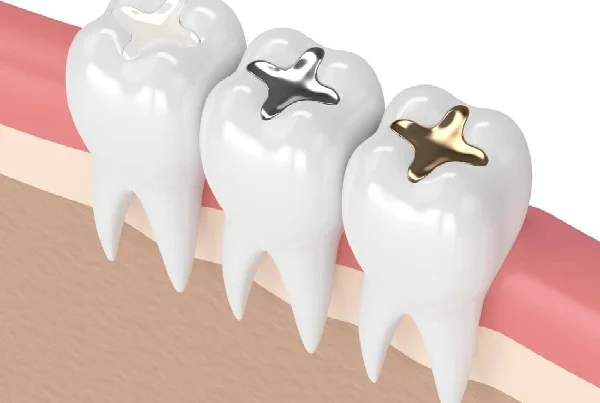 Tooth Coloured Filling