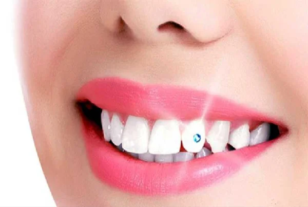 Dental Jewellery