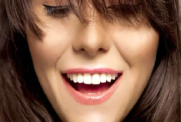 Dental Veneers