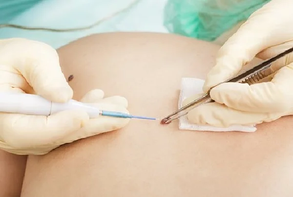 Mole and Scar Removal