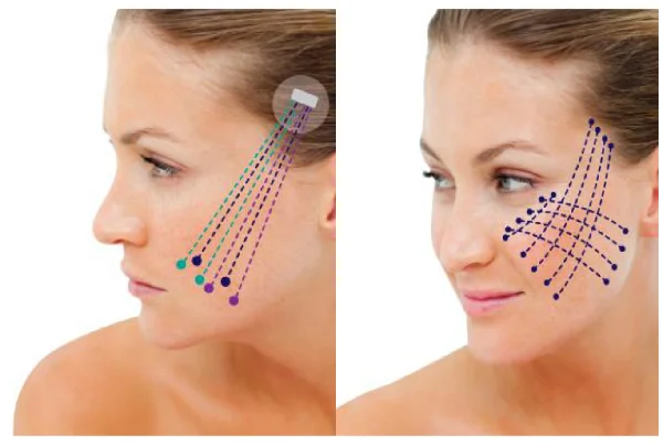 Thread Facelifts